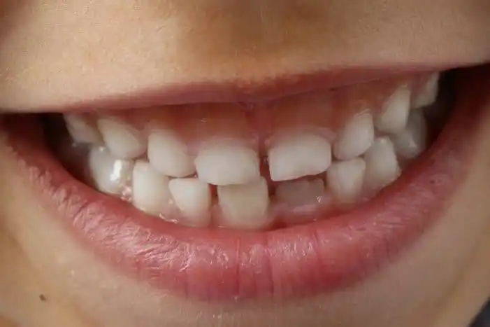 Tips Membersihkan Gigi Yang Tepat Dan Benar Agar Jauh Dari Karang Gigi